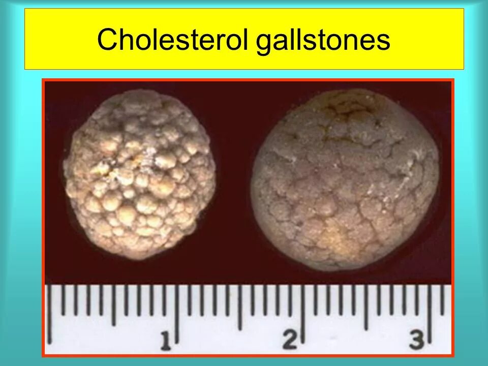 Холестериновые камни в желчном. Известковые камни в желчном пузыре. Камни из желчного пузыря холестериновые. Холестериновые конкременты жёлчного пузыря.