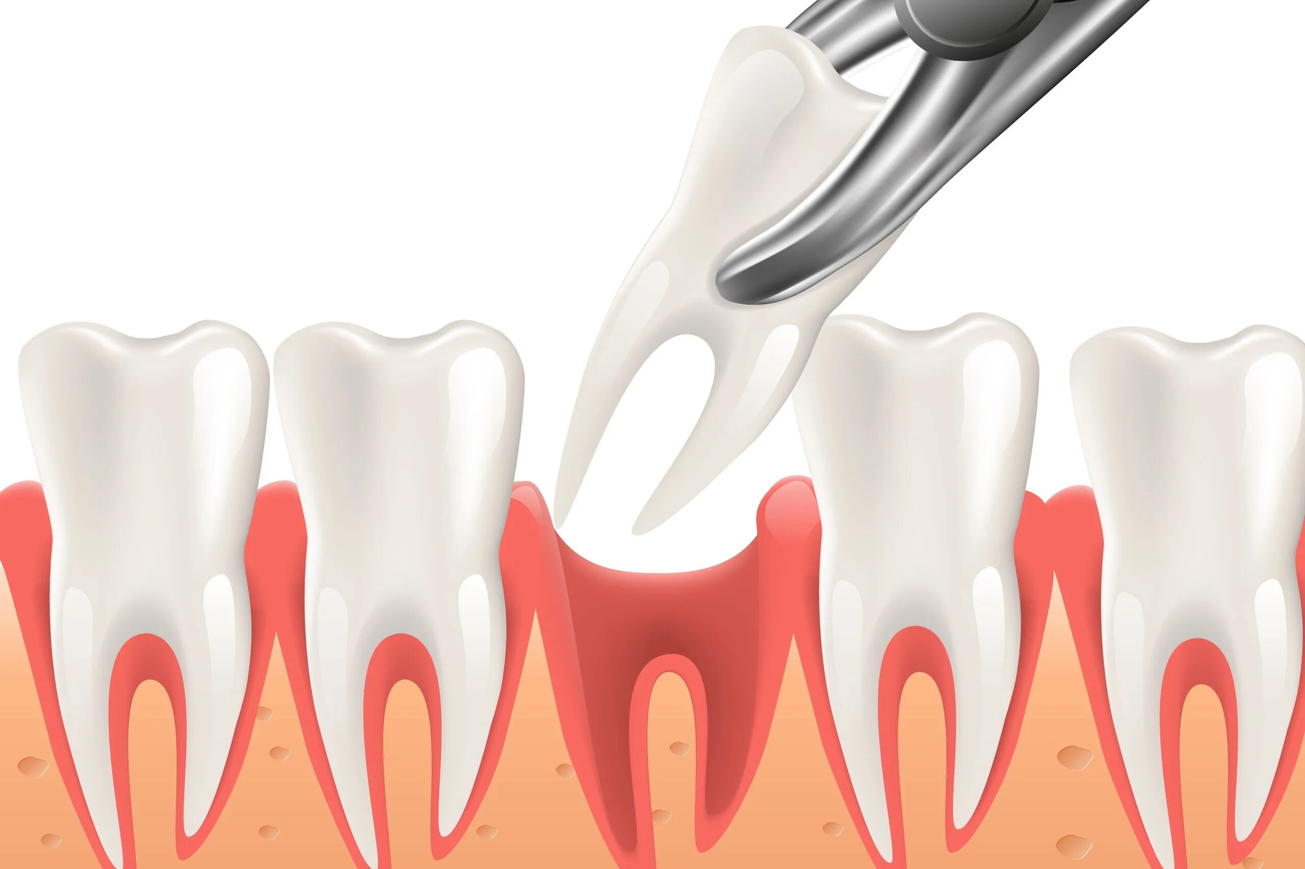 Сложное удаление зуба. Зуб 3d вектор. Гингивит Векторная Графика. Вектор для зубов и десен резинки.