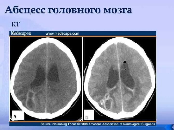 Абсцесс мозга. Абсцесс лобной доли кт. Кт при абсцессе головного мозга. Абсцесс лобной доли мозга симптомы.