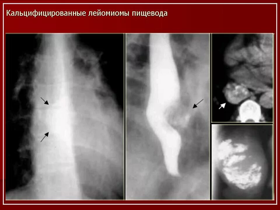 3 пищевода. Лейомиома пищевода рентгенограмма. Лейомиома желудка рентген. Доброкачественная опухоль пищевода рентген.