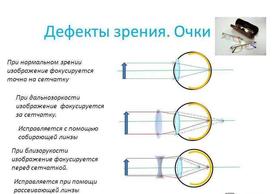 Как можно скорректировать дальнозоркость. Дефект зрения близорукость и дальнозоркости физика линзы.. Способы коррекции дефектов зрения. Аномалии рефракции глаза близорукость дальнозоркость таблица. Дефекты зрения дальнозоркость и близорукость и их коррекция.