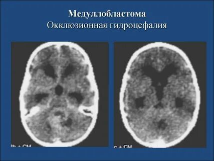 Гидроцефалия киста