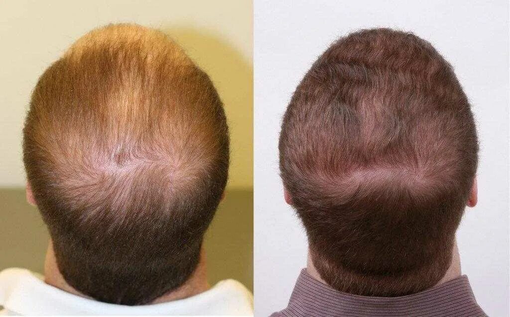 Восстановление волос роста отзывы. Плазмолифтинг для волос мужчинам. Мезотерапия для волос. Мезотерапия волос мужчин.
