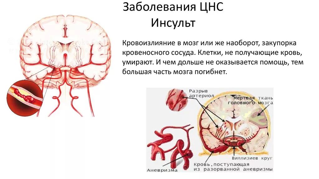 Причины заболеваний головного мозга. Классификация сосудистых заболеваний центральной нервной системы. Инсульт это заболевание нервной системы. Сосудистая патология нервной системы. Поражение центральной нервной системы.