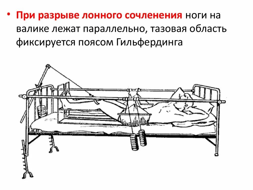 Скелетное вытяжение костей таза. Перелом таза скелетное вытяжение. Скелетное вытяжение при переломе костей таза. Склетная вытяжения перелометаза.