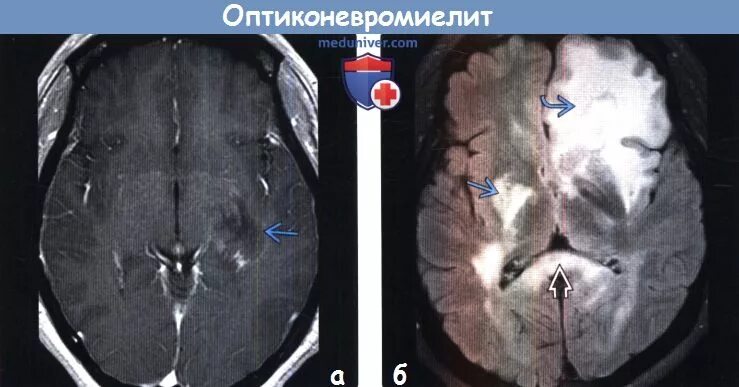 Оптикомиелит девика. Болезнь девика. Нейрооптикомиелит болезнь. Оптиконевромиелит болезнь девика. Заболевание спектра оптиконевромиелита.