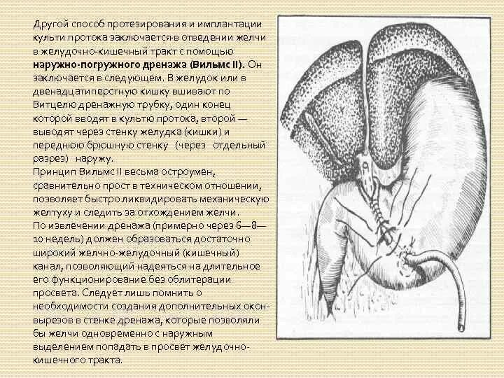 Методы дренирования желчного пузыря. Дренажная трубка для желчных протоков. Дренажная трубка желчного протока. Дренаж желчного пузырного протока.