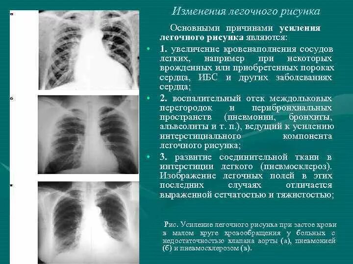 Изменение легкие степени. Синдром изменения легочного рисунка рентген. Усиление лёгочного рисунка на рентгенограмме. Синдром патологии легочного рисунка рентген. Усиление легочного рисунка легкого рентген.