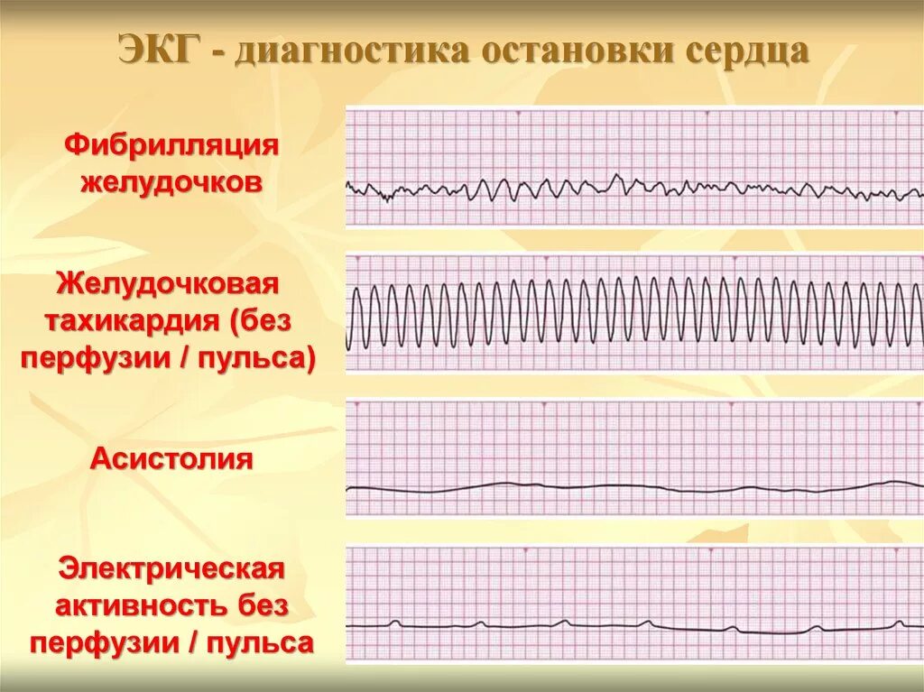 Фибрилляция желудочков без пульса ЭКГ. Асистолия и фибрилляция желудочков на ЭКГ. Виды остановки сердца. Электрическая активность сердца без пульса на ЭКГ.