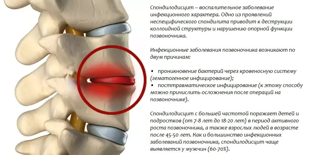 Последствия блокады позвоночника. Спондилодисцит шейного отдела позвоночника. Блокада грыжа межпозвоночного диска. Блокада позвоночника при грыже. Блокада шейного отдела позвоночника при остеохондрозе.