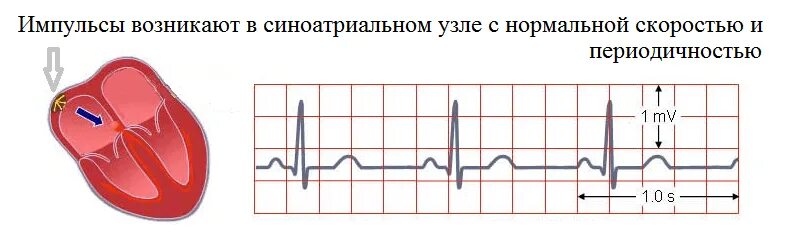 что значит синусовый ритм сердца у взрослого. ритм синусовый экг чсс73. синусовый ритм норма у женщин. 80-100 чсс синусовая аритмия. электрокардиограмма показатели синусовый ритм.
