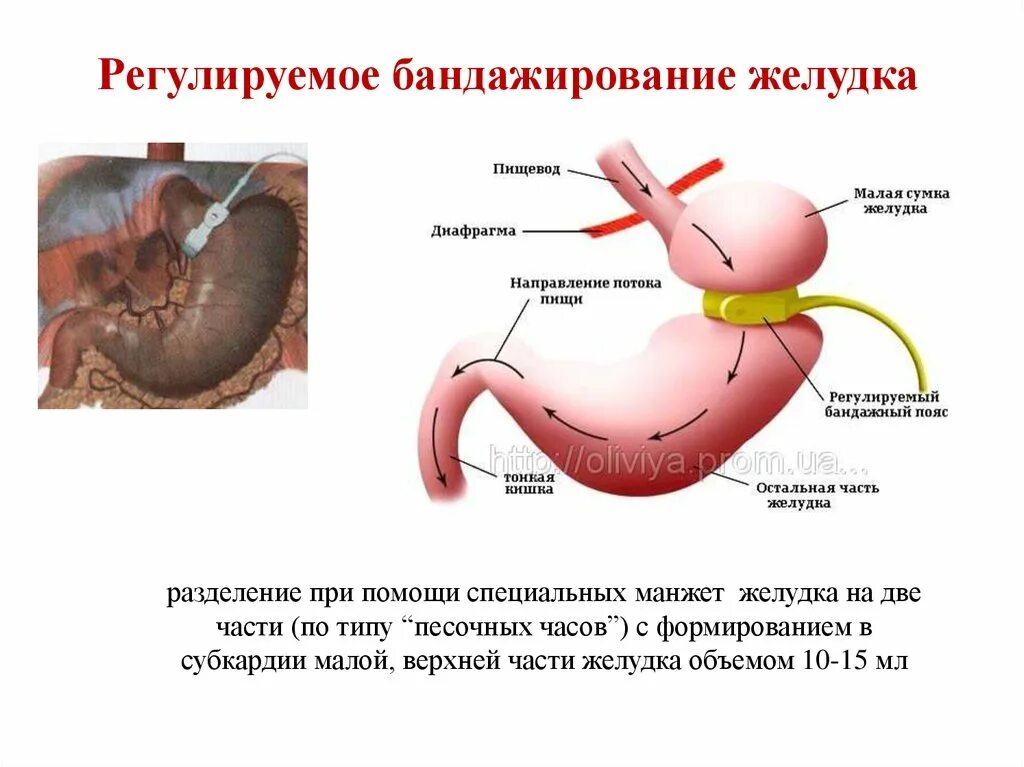 Умер от резекции желудка. Шунтирование желудка схема операции. Операция бандажирования желудка. Операции по регулируемому бандажированию желудка. Шунтирование бандажирование резекция желудка.