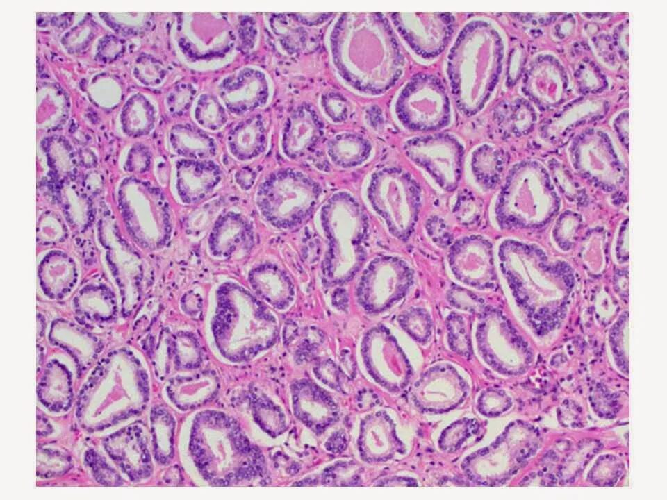 Глисон простата. Аденокарцинома предстательной железы гистология. Парауретральные железы гистология. Аденома поджелудочной железы гистология. Аденома потовых желез гистология.