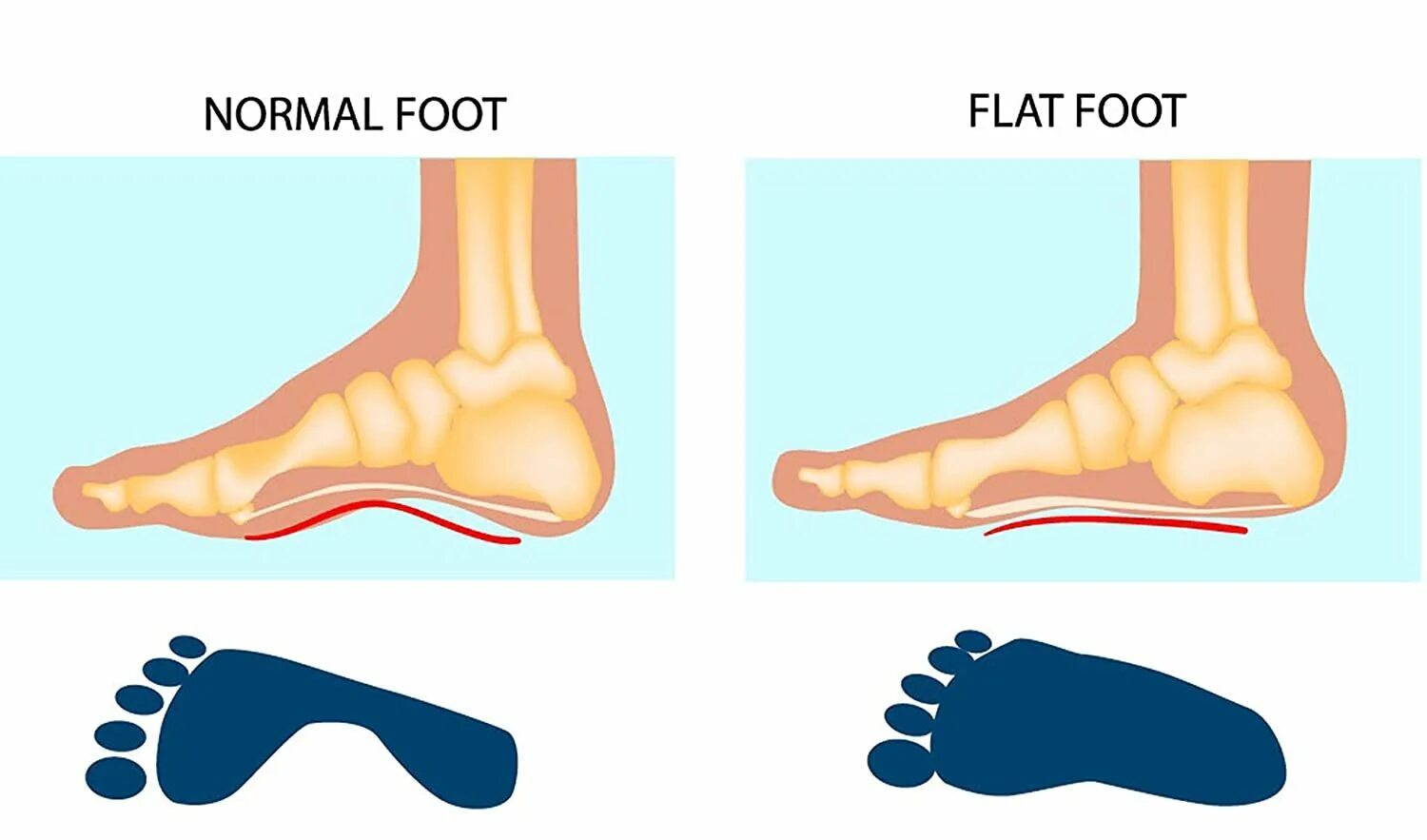 Средняя стопа. Сводчатая стопа и плоскостопие. Нормальная стопа и плоскостопие. Стопа здорового человека и плоскостопие.