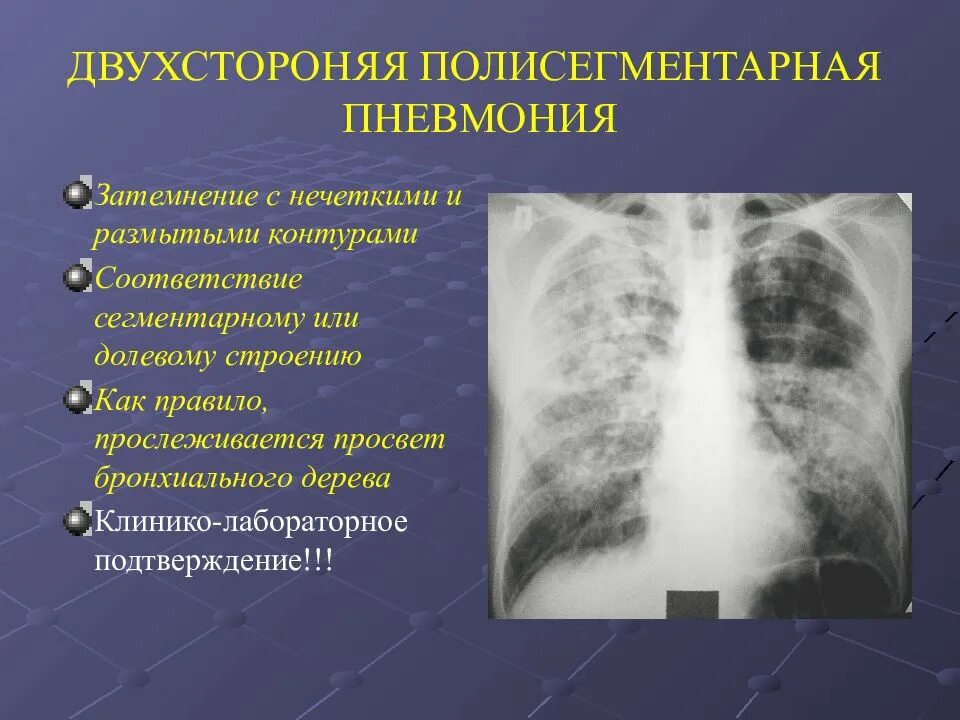 Двухсторонняя полисегментарная пневмония кт1. Левосторонняя полисегментарная пневмония рентген. Интерстициальная пневмония. 2 Х сторонняя полисегментарная пневмония рентген.