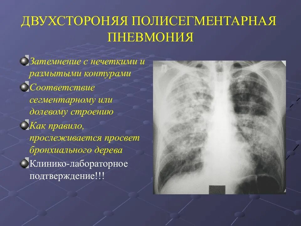 10 поражение легких. Двухсторонняя полисегментарная пневмония кт1. Левосторонняя полисегментарная пневмония рентген. Интерстициальная пневмония. 2 Х сторонняя полисегментарная пневмония рентген.