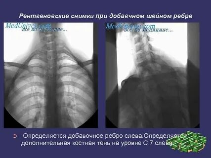 Шейные ребра