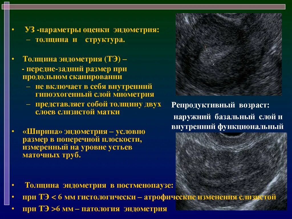 Эндометрия разрастается. Ультразвуковые критерии гиперплазии эндометрия. Железистая гиперплазия эндометрия УЗИ. Гиперплазия эндометрия по УЗИ. Гиперпластические процессы эндометрия УЗИ.