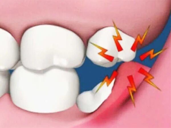Перикоронарит воспаление. Острый Гнойный перикоронарит. Ретинированный дистопированный зуб мудрости. Перикоронарит симптомы. Зубы болят и сверху и снизу