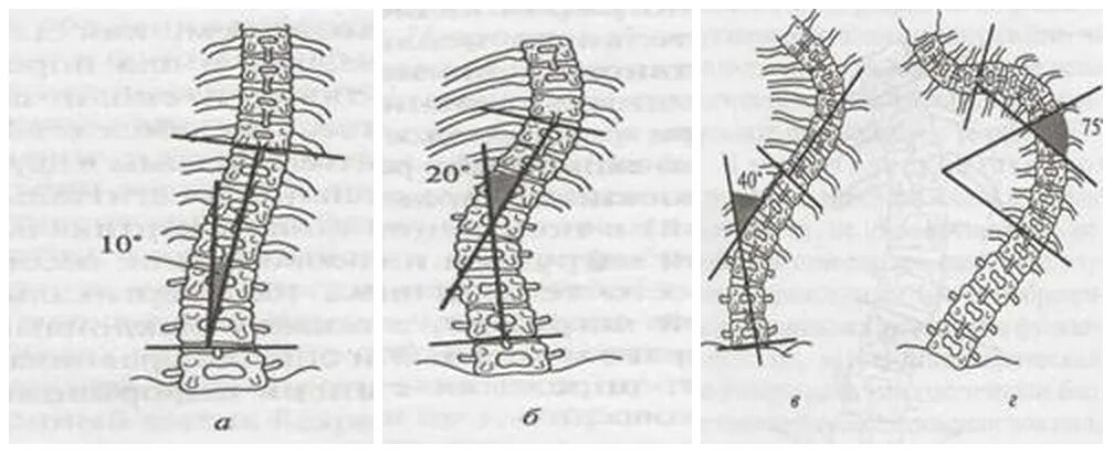 Искривление позвоночника градусы. Сколиоз угол искривления 17 градусов. S образный сколиоз 1 степени по чаклину. Сколиоз позвоночника 2 степени угол искривления. Сколиоз 2 степени угол искривления 17.