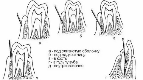 Заморозить зуб спрей. Герметизация фиссур на молочных. Герметизация фиссур у детей. Через сколько отходит заморозка зуба. Что такое периодонтит в стоматологии.