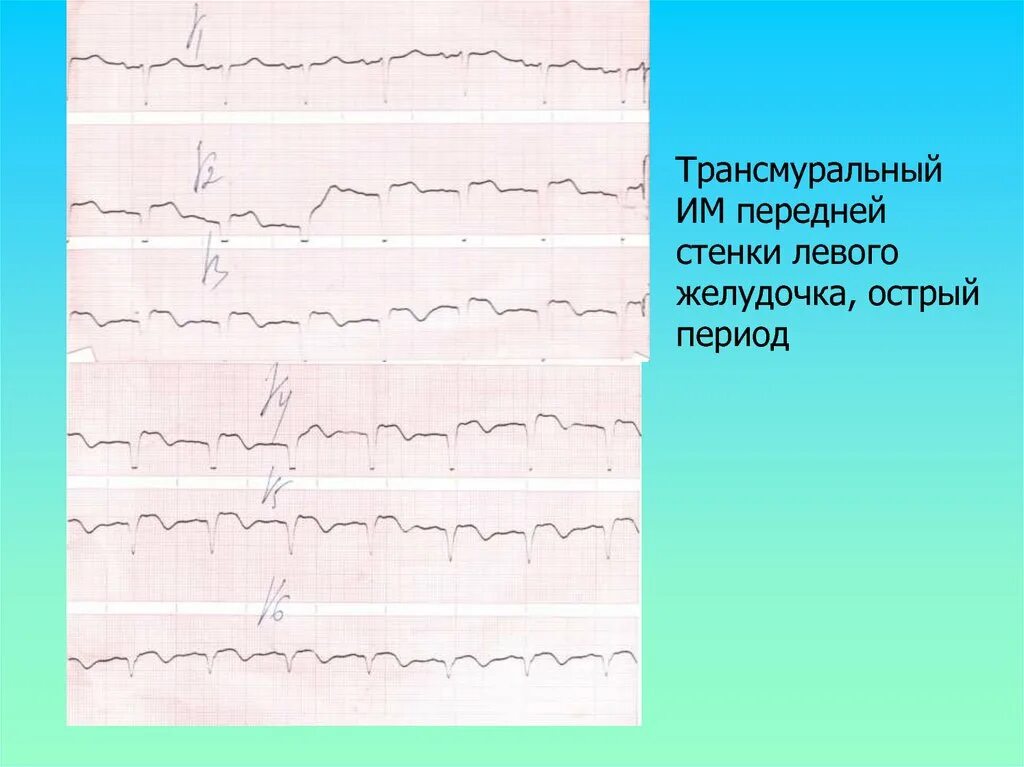 Инфаркт миокарда трансмуральный нижней стенки 121. Острый инфаркт передней стенки левого желудочка. Острый инфаркт передней стенки левого желудочка. Острый инфаркт миокарда задней стенки левого желудочка. Инфаркт миокарда нижней стенки экг.
