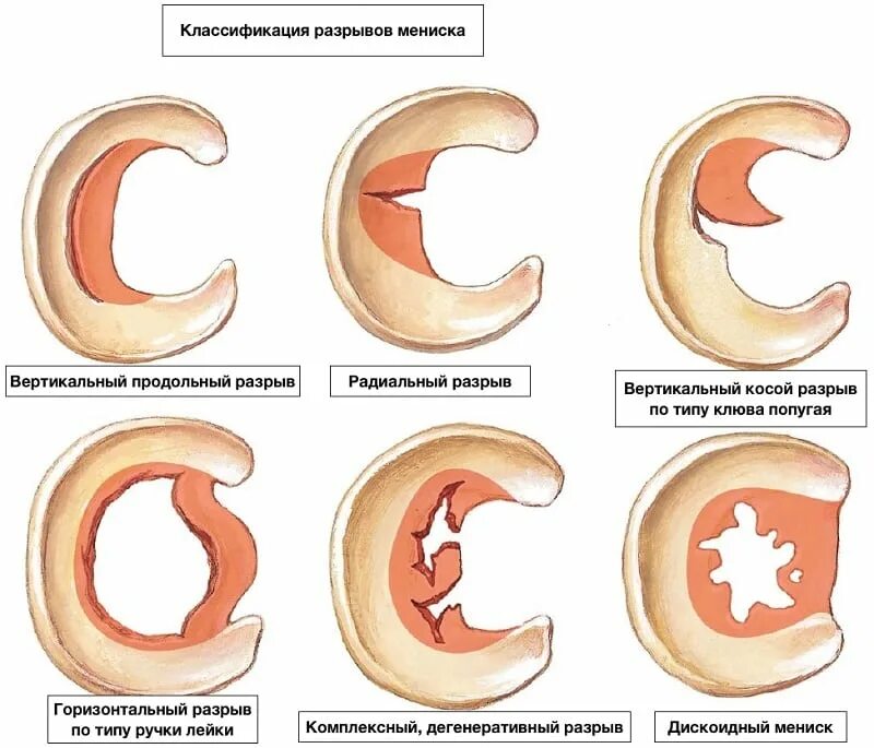 Дистрофические изменения заднего рога. Косо горизонтальный разрыв медиального мениска 3 степени. Разрыв заднего рога мениска мениск коленного сустава. Задний Рог медиального мениска 3 степени. Повреждениезаднего рога медиалтного мениска 3а степени.