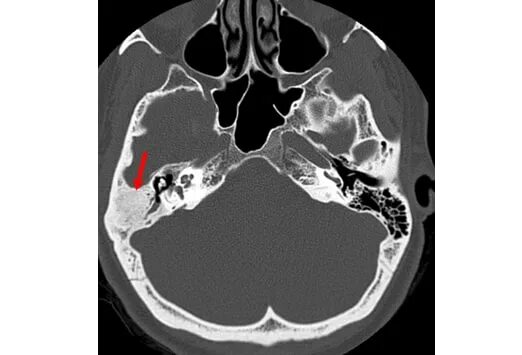 Остеома височной кости кт. Сосцевидный отросток височной кости кт. Невринома мосто-мозжечкового угла кт. Утолщение слизистой сосцевидного отростка