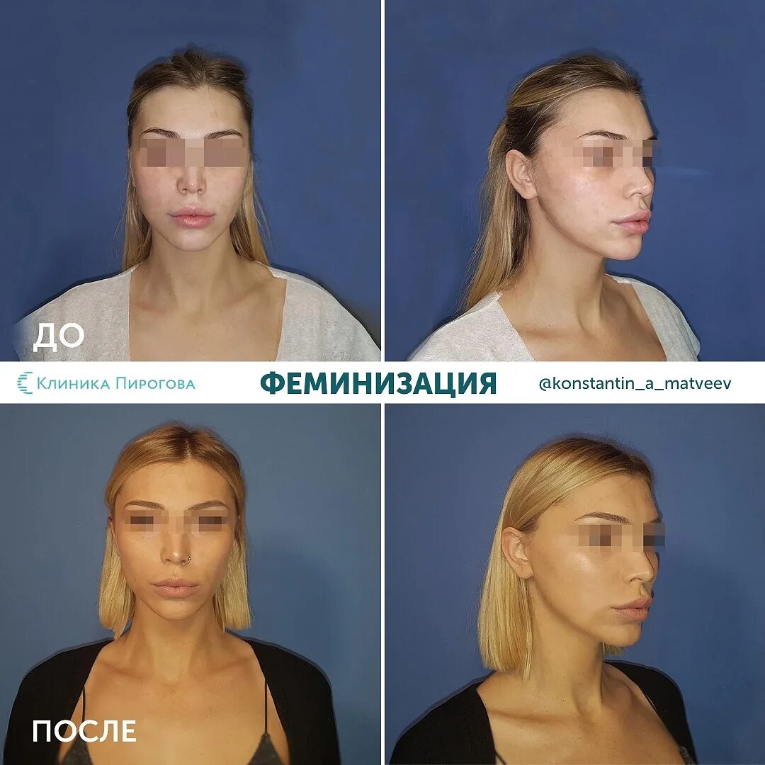 Хирургическая феминизация лица. Феминизация лица. Операция по феминизации лица до и после. Операция по феминизации лица. Феминизация лица до и после мужчины.