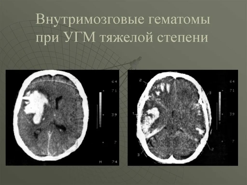 Внутримозговая гематома мрт. Внутримозговая гематома кт. Ушиб головного мозга тяжелой степени кт. Кт внутримозговая гематома головного мозга.