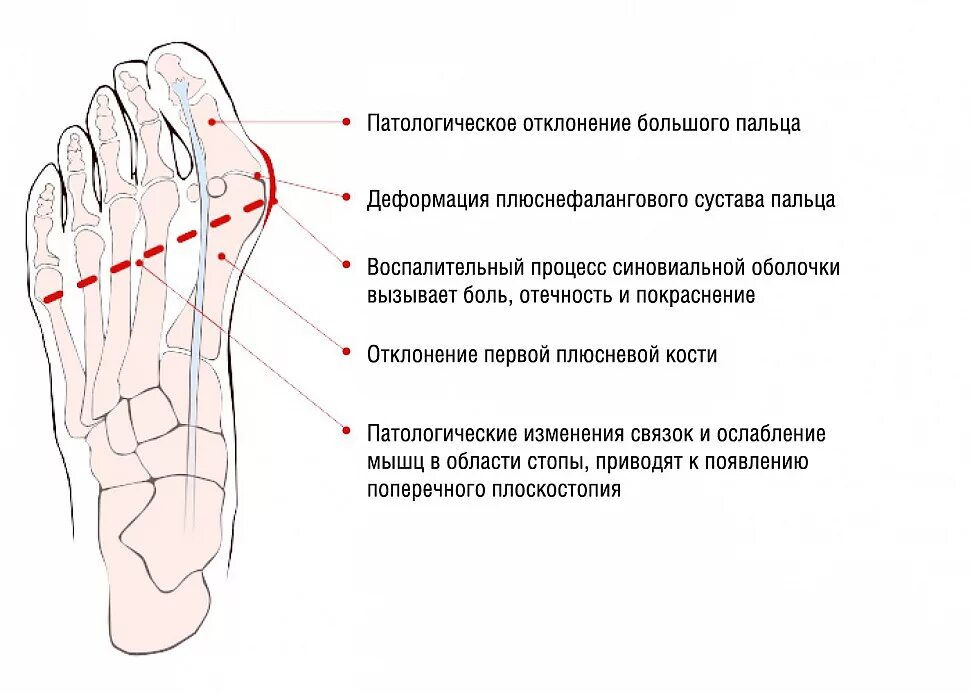 Болит стопа снизу. Болит большой палец на ноге при ходьбе сбоку. Суставы стопы схема. Отклонение большого пальца стопы.