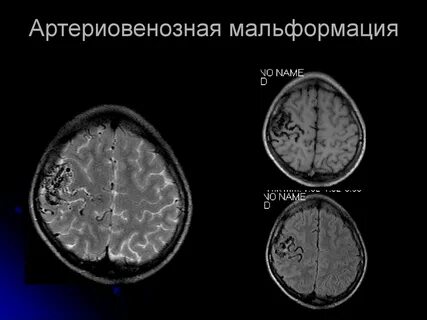 Венозная мальформация лечение