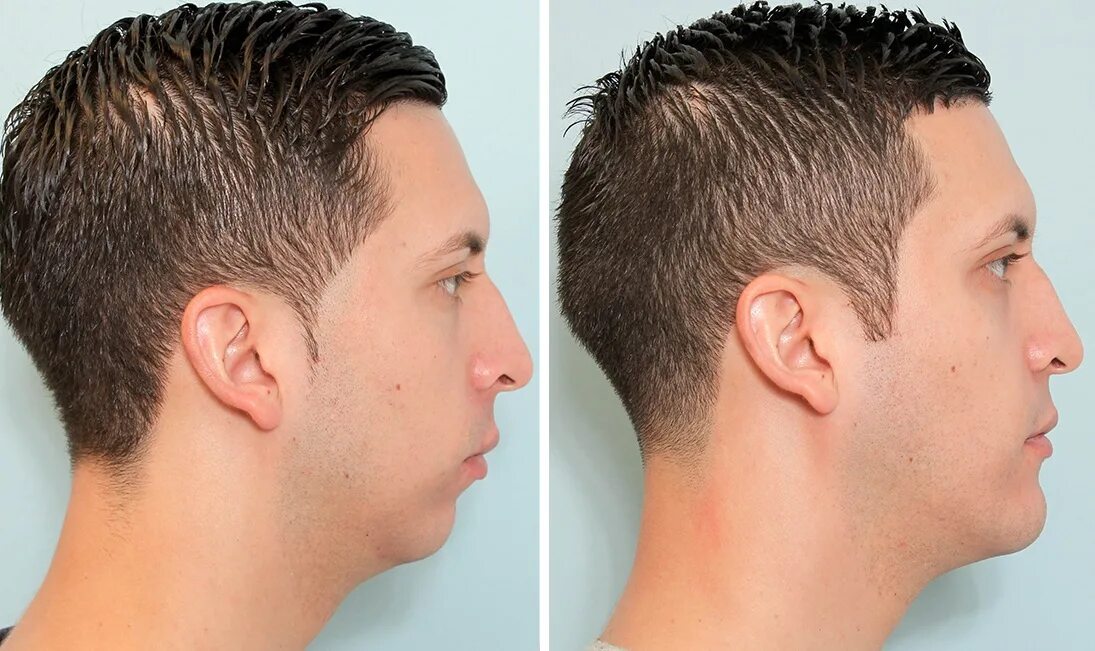 Как сделать подбородок меньше. Остеотомическая ментопластика. Ортогнатическая операция мезиальный прикус. Ментопластика мезиальный прикус. Брекеты до и после лицо в профиль.