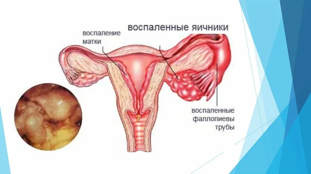 Воспаление придатков как называется. Воспаление придатков как называется