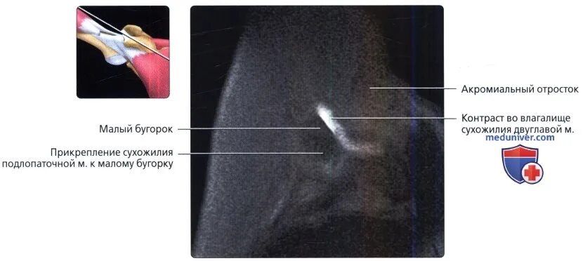 Отросток во влагалище фото. Прекардиальная область. Строение остистого отростка позвонка. Соустья гайморовых пазух. Перелом поперечного отростка позвоночника.