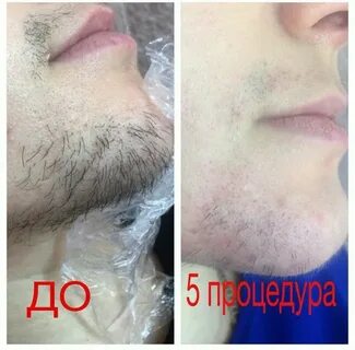 Электроэпиляция ростов на дону