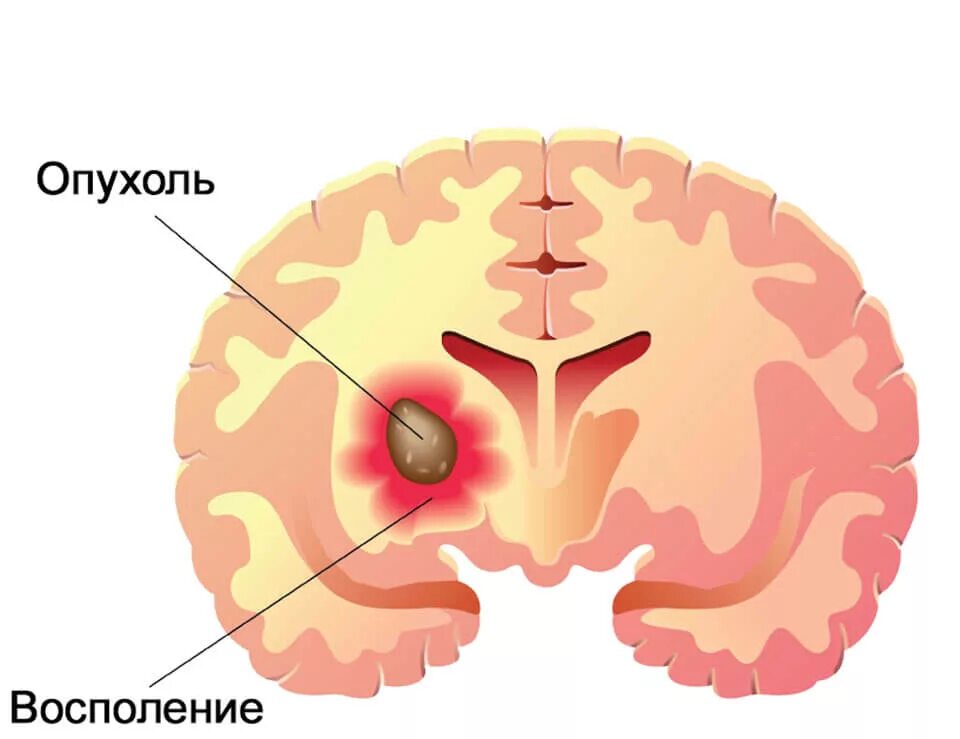 Новообразование в головном мозге. Доброкачественная опухоль головного мозга. Опухоль головного мозга рисунок. Злокачественное новообразование мозга