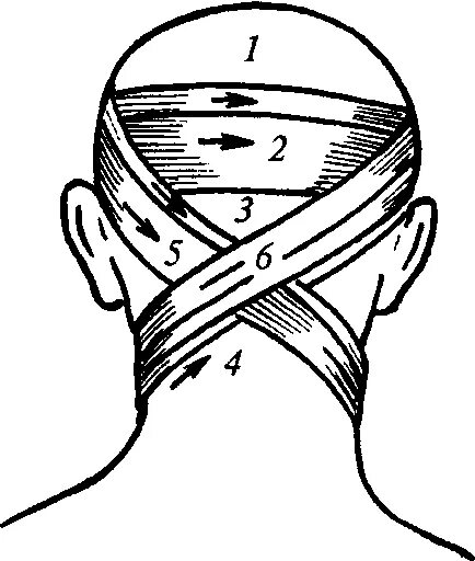 Крестообразная на затылок. Крестообразная (восьмиобразная) повязка. Десмургия крестообразная повязка. Техника наложения крестообразной повязки на затылок. Десмургия восьмиобразная повязка.