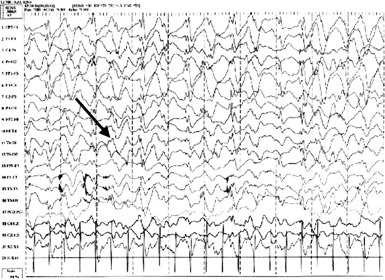 Синдром Ангельмана ЭЭГ. Гипсаритмия на ЭЭГ. Синдром Леннокса-Гасто ЭЭГ. Синдром Драве ЭЭГ.