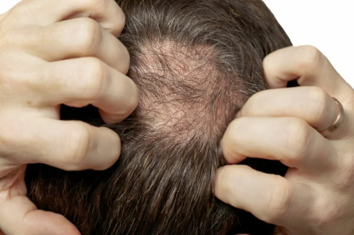 Выпадение волос у мужчин лечение. Волосы.