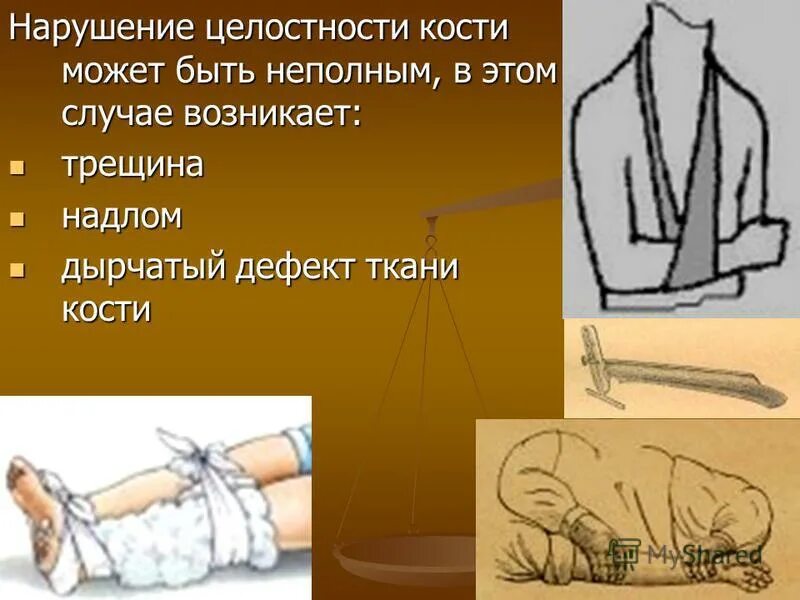 Перелом это разрушение мягких тканей костей. Закрытые переломы презентация. Тест на тему переломы с ответами. Перелом это разрушение мягких тканей костей. Открытый и закрытый перелом.