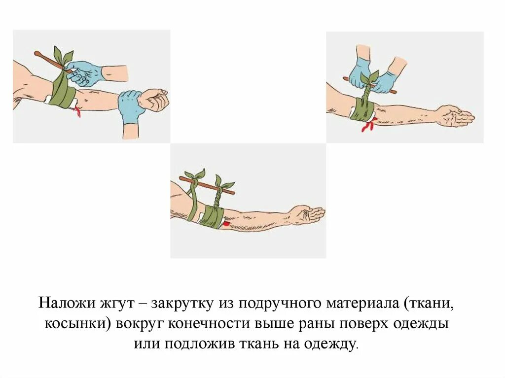 Наложение жгута закрутки. Правила наложения жгута закрутки. Наложение кровоостанавливающего жгута или жгута закрутки. Наложение кровоостанавливающего жгута закрутки.