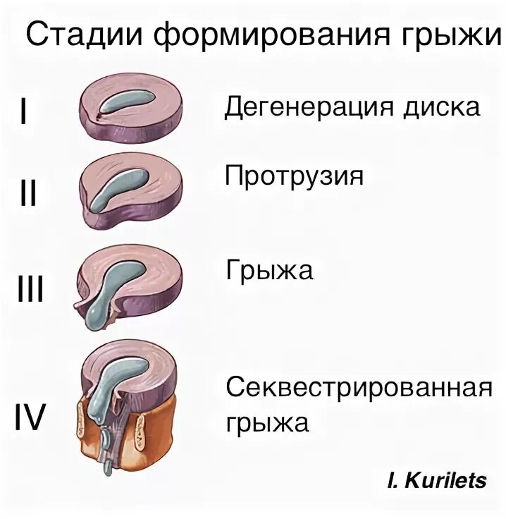 медианная грыжа межпозвонкового диска l5-s1. межпозвонковые диски l2,l3, l4. протрузия грыжа межпозвонковых дисков. степень грыжи позвоночника. протрузия позвонков поясничного отдела.