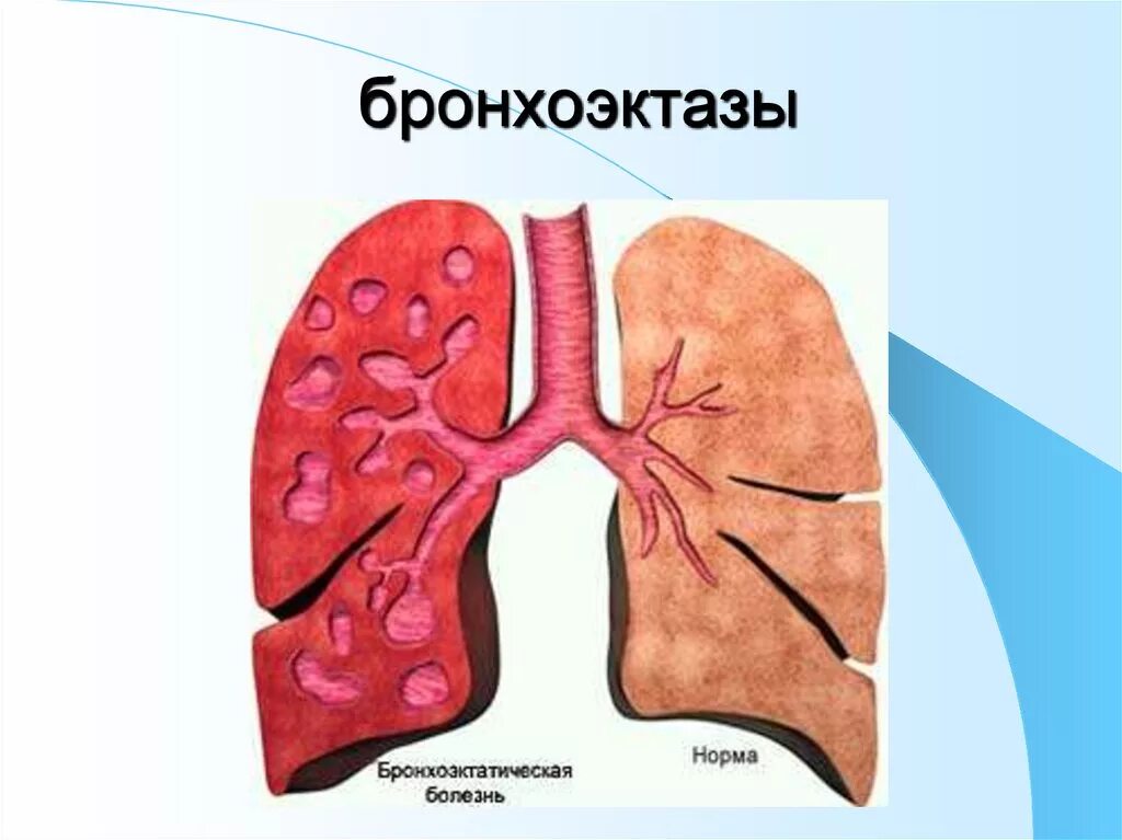 Что такое бронхоэктазы. Бронхоэктатическая болезнь. бронхоэктатическая астма. врожденные бронхоэктазы. бронхоэктатическая болезнь легких.