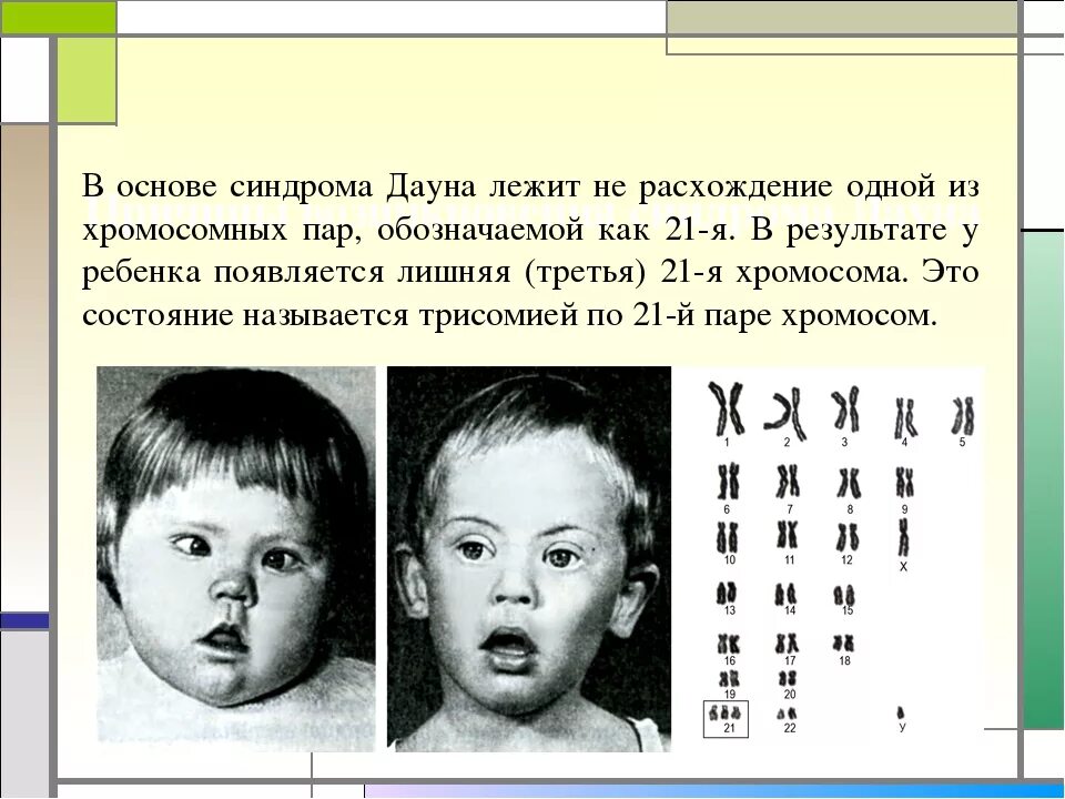 Болезнь дауна какой. Геномные болезни синдром Дауна. Синдром Дауна трисомия. Синдром Дауна хромосомная мутация.