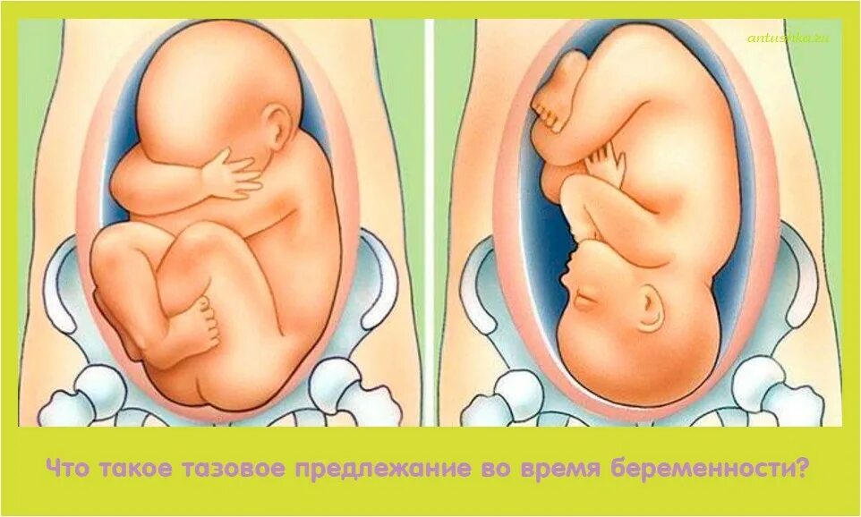 33 недели часто. Расположение ребенка в тазовом предлежании. Головное предлежание плода на 33 неделе. Ягодичное предлежание плода 33 недели. Положение малыша в животе.