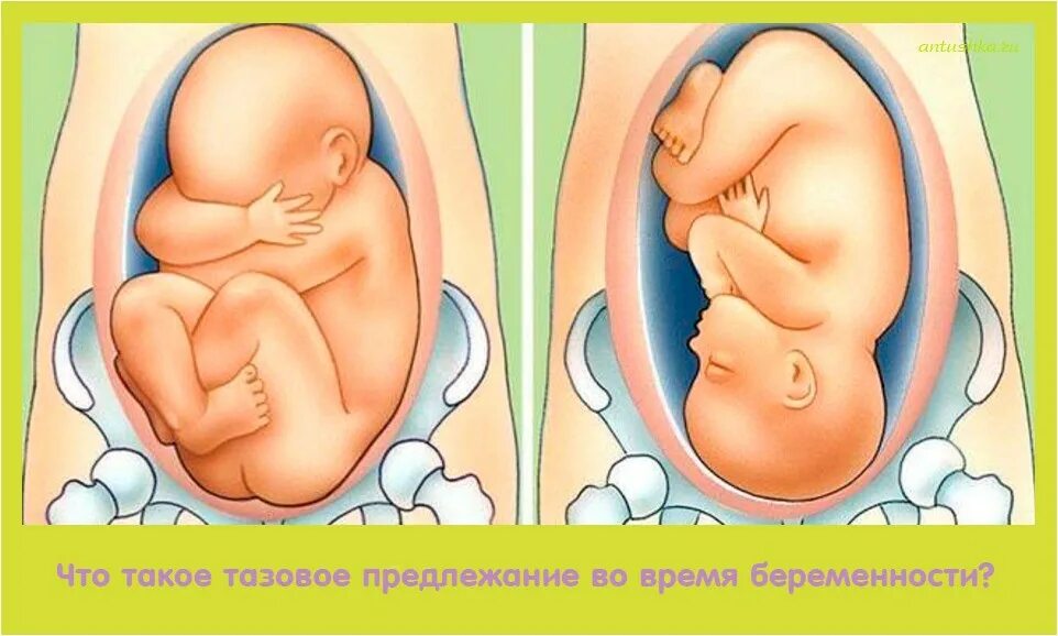 33 недели назад. Расположение ребенка в тазовом предлежании. Головное предлежание плода на 33 неделе. Ягодичное предлежание плода 33 недели. Положение малыша в животе.