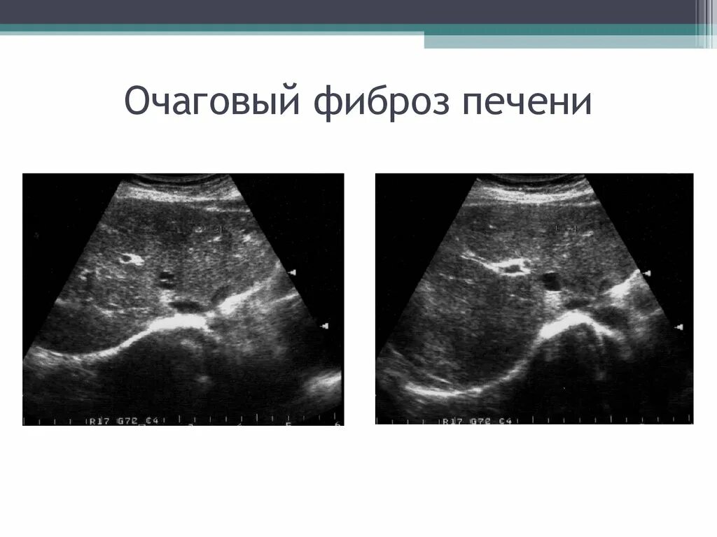 Сколько живут фиброзом 4. Перипортальный фиброз УЗИ. Перидуктальный фиброз печени УЗИ. Перипортальный фиброз печени на УЗИ. Кардиальный фиброз печени на УЗИ.