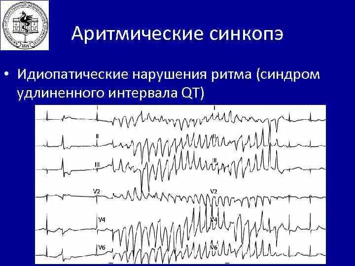 Синдром удлиненного интервала qt. Синдром удлиненного интервала qt на ЭКГ. Врожденный синдром удлиненного интервала qt. Синдром удлиненного интервала qt типы.