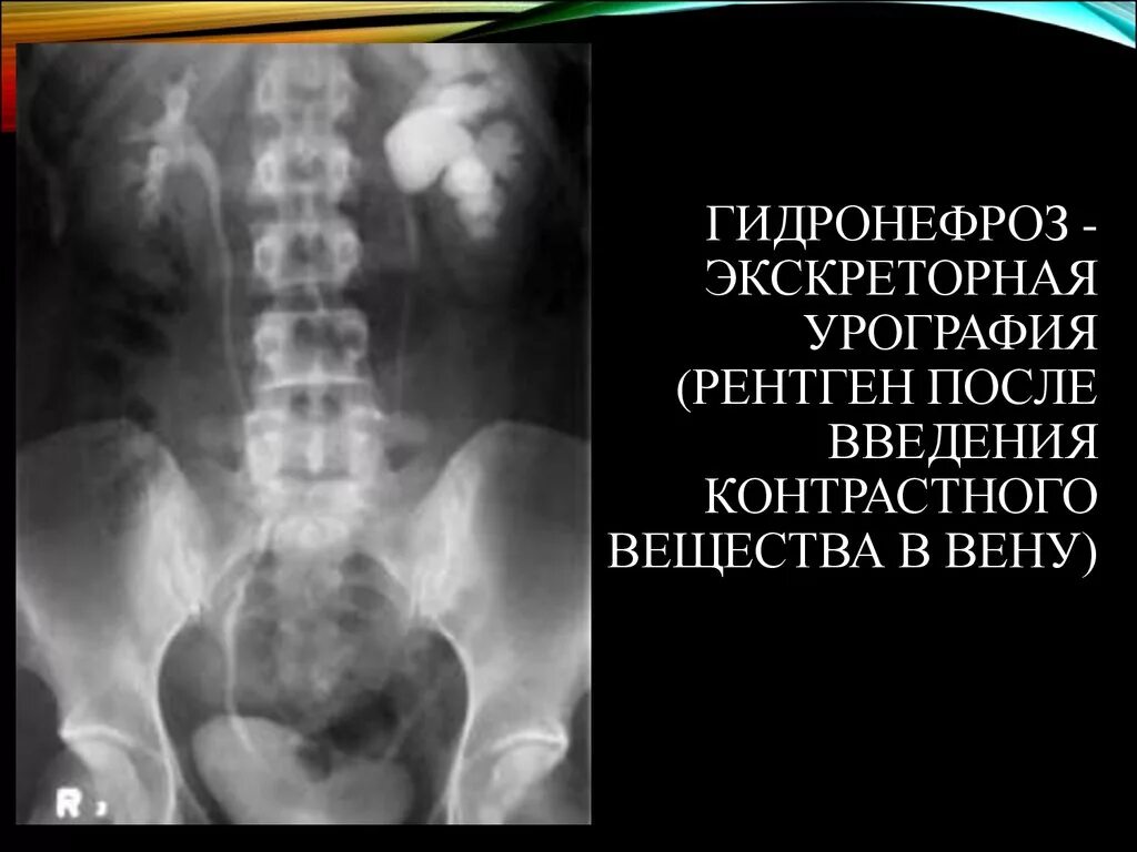 После урографии